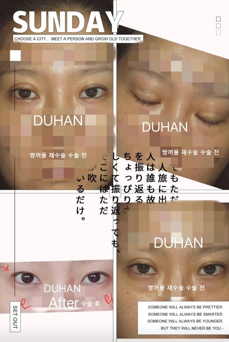 쌍꺼풀 재수술은 역시 전문가에게! 솔직후기 관련 이미지 1