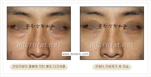 [두한성형외과 경쟁력 눈밑성형] - [눈밑지방제거, 눈위지방제거 안내 2.] 관련 이미지 9