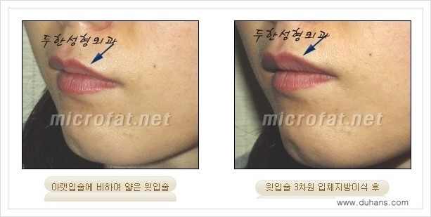 [두한성형외과 경쟁력 미세지방이식] - [입술 미세지방이식 안내] 관련 이미지 1