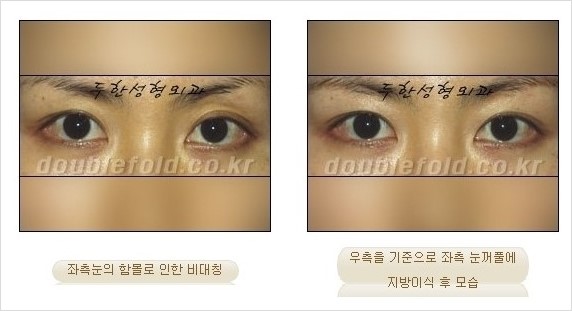 [두한성형외과 경쟁력 쌍꺼풀 재수술] - [쌍꺼풀 재수술 과정] 관련 이미지 99