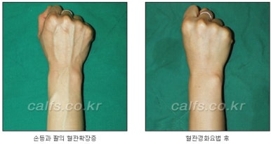두한성형외과 보기싫은 혈관제거 - 눈밑혈관, 손과 팔의 혈관확장증 치료 관련 이미지 31
