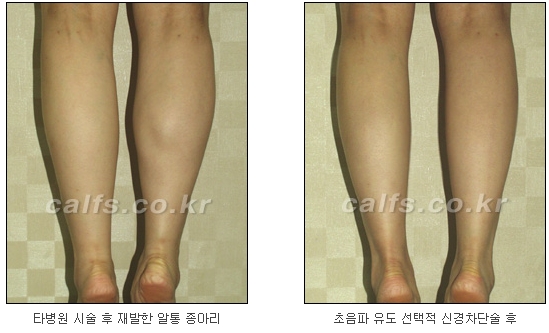 [두한성형외과 종아리퇴축술] - [NO절개! 초음파유도신경차단술] 관련 이미지 18