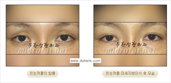 [두한성형외과의 경쟁력 NO.1 지방이식] - [눈꺼풀 미세지방이식 관련 자주하는 질문과 답변] 관련 이미지 4