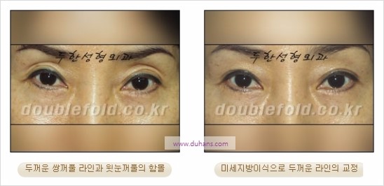 [두한성형외과 경쟁력 눈성형] - [쌍꺼풀 재수술에 대한 최선의 대안 제시] 관련 이미지 23