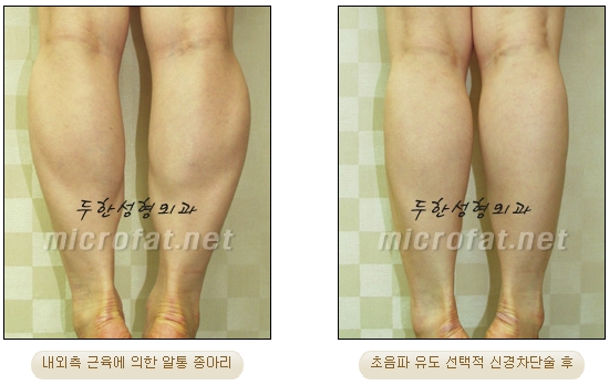[Duhan Plastic Surgery Clinic Calf Contouring] - [Calf Reduction] image 20