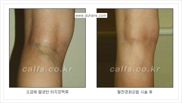 [두한성형외과 경쟁력 멀티종아리성형] - [나에게 맞는 종아리성형 방법의 종류 안내 3.] 관련 이미지 14