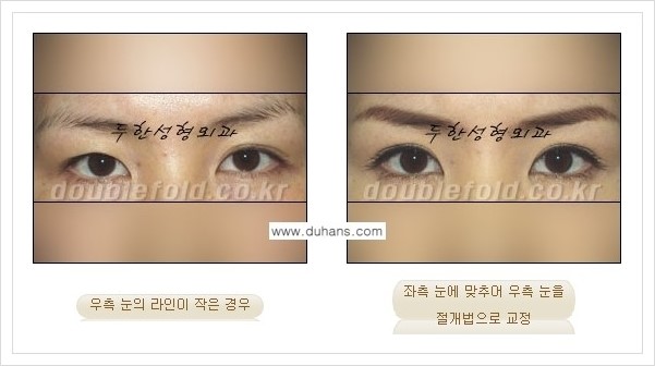 [두한성형외과 경쟁력 눈성형] - [짝짝이(비대칭) 쌍꺼풀 라인 교정하는 방법 안내 1.] 관련 이미지 5