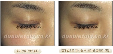 [두한성형외과 쌍커플 재수술] - [비절개눈매교정 재수술] 관련 이미지 23