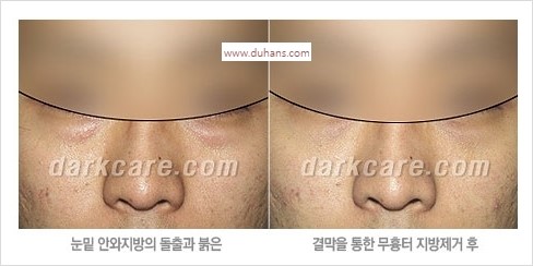 [두한성형외과 경쟁력 눈밑성형] - [눈밑 안와지방 돌출의 무통마취 무흉터 눈밑지방제거 안내] 관련 이미지 8
