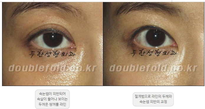 [Double Eyelid Surgery Duhan Plastic Surgery] - [Revision Methods] image 33