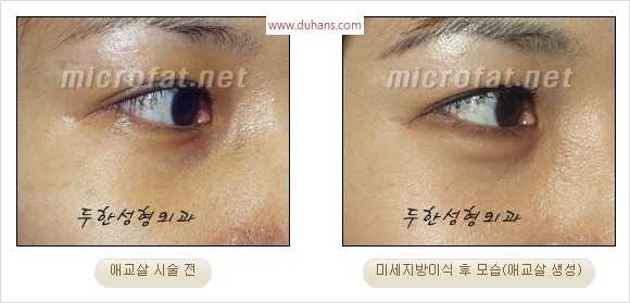 ​﻿[두한성형외과 경쟁력 지방이식] - [눈밑 애교살 시술을 위한 미세지방이식] 관련 이미지 7