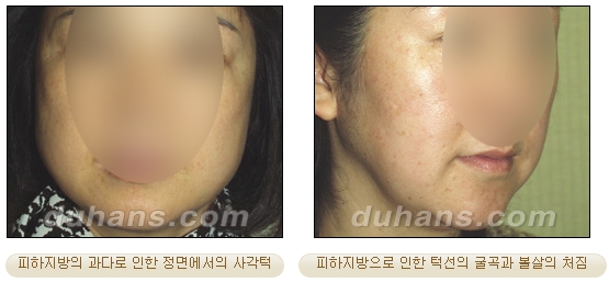 [두한성형외과 안전한 지방흡입] - [얼굴지방흡입] 관련 이미지 2