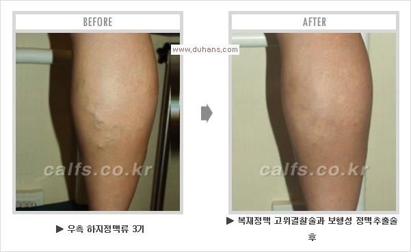 [두한성형외과 경쟁력 멀티종아리성형] - [지방흡입이 필요한 종아리 비만 안내] 관련 이미지 20