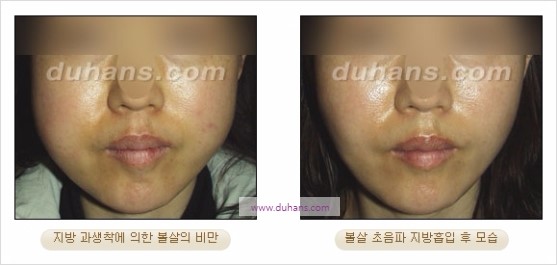 [두한성형외과 경쟁력 지방흡입] - [볼살, 턱선의 간편 지방흡입] 관련 이미지 20
