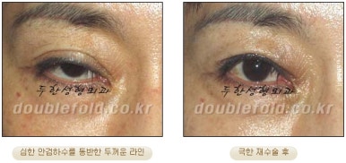 쌍꺼풀수술 두한성형외과 - 쌍커풀재수술의 문제점 관련 이미지 18