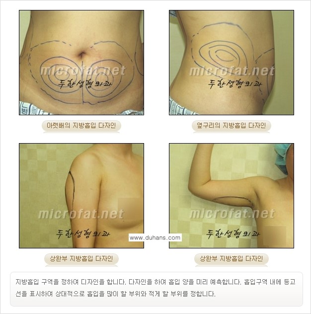 [두한성형외과 겨울엔 지방흡입 도전] - [간편한 복부지방흡입 1.] 관련 이미지 7