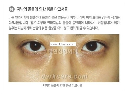 [두한성형외과 경쟁력 눈밑성형] - [다크써클의 종류] 관련 이미지 2