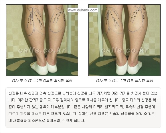 [두한성형외과 경쟁력 멀티종아리성형] - [종아리성형 방법별 전후 주의사항] 관련 이미지 6