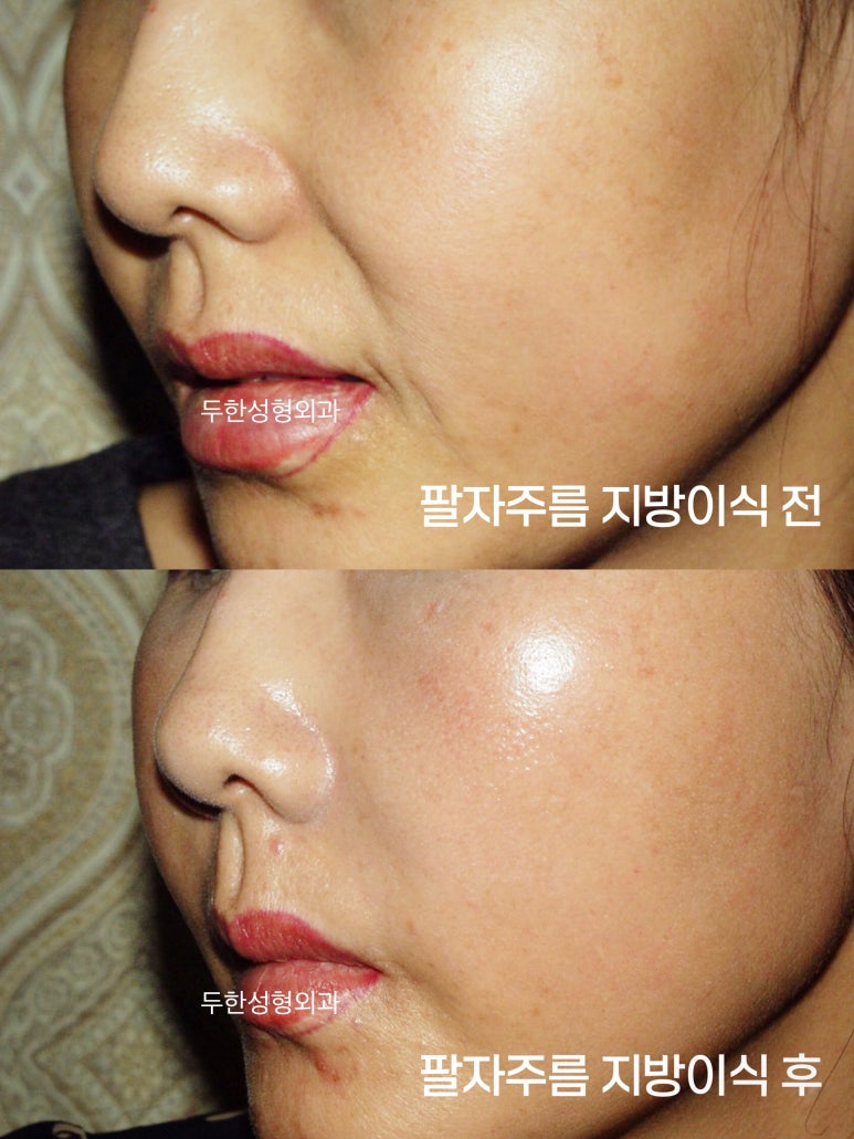 팔자 지방이식, 단순히 채우는 것보다 중요한 것은? 관련 이미지 2