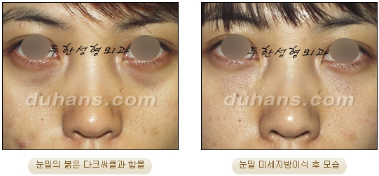 [두한성형외과 지방이식] - [눈밑 다크써클] 관련 이미지 11