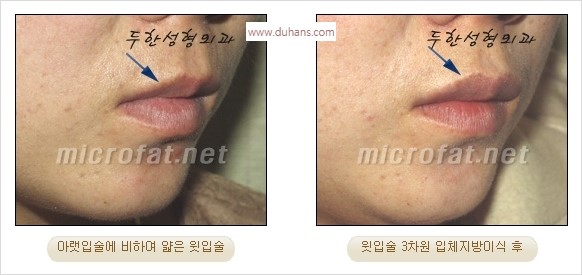​​[두한성형외과 경쟁력 미세지방이식] - [볼륨감 있는 입술성형] 관련 이미지 17