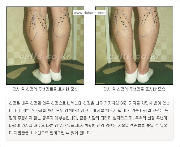 [두한성형외과 경쟁력 종아리성형] - [초음파 유도 선택적 신경차단술 안내 ②] 관련 이미지 6