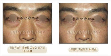 두한성형외과 눈밑수술 - 다크서클 수술 전후 관리 안내 관련 이미지 63