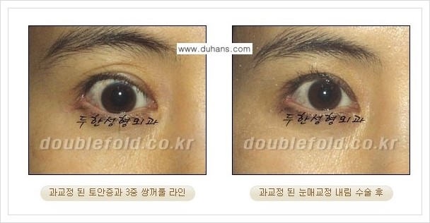 [두한성형외과 경쟁력 쌍꺼풀 재수술, 극한 눈재수술] - [과교정 된 눈매교정] 관련 이미지 1