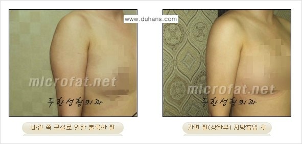 [두한성형외과 간편 지방흡입] - [팔, 팔뚝, 팔뚝살, 상완부 지방흡입 시술의 예] 관련 이미지 5