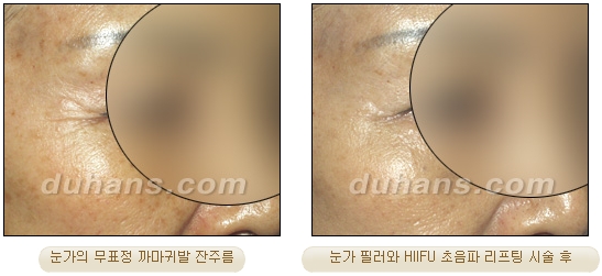 [Duhan Plastic Surgery Lift] - [Double Chin, Drooping Cheeks, Sagging Neck Skin, Wrinkle Improvement] image 26