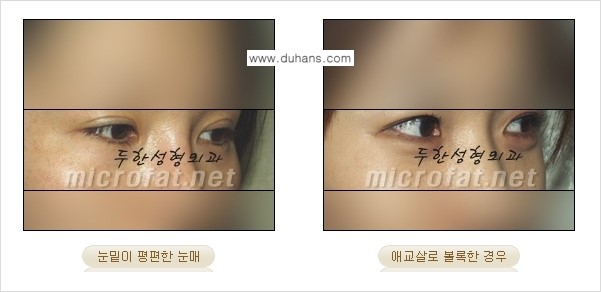[두한성형외과의 경쟁력 있는 지방이식] - [눈밑 애교살 미세지방이식 1.] 관련 이미지 2