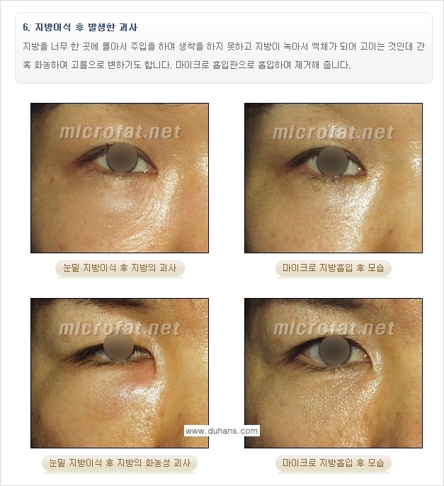 [두한성형외과 "미세지방이식"] - [지방이식 부작용 교정 정보 ③] 관련 이미지 6