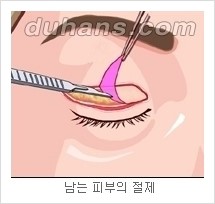 [두한성형외과 경쟁력 눈성형] - [젊은 눈매로의 복원 안검성형] 관련 이미지 4