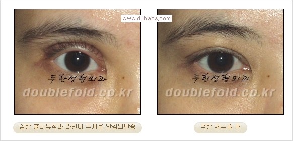 [두한성형외과 경쟁력 쌍꺼풀 재수술, 극한 재수술]- [쌍꺼풀 재수술의 성공 조건(Condition of successful reoperation) 관련 이미지 13