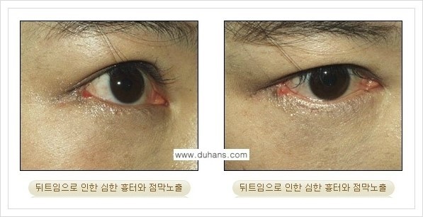 [두한성형외과 경쟁력 쌍꺼풀 재수술, 극한 눈재수술] - [뒤트임 수술의 부작용 및 교정 방법 안내] 관련 이미지 11