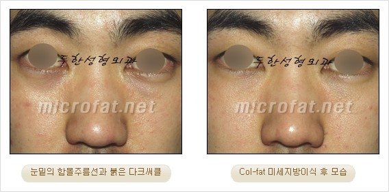 ​[두한성형외과 경쟁력 눈밑성형 리더] - [눈밑 다크써클의 증상, 원인, 종류, 치료방법 안내] 관련 이미지 39