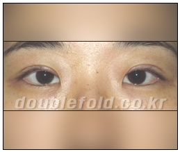 [DuHan Plastic Surgery Eye Surgery] - [Guide to Epicanthoplasty and Canthoplasty for Increasing the Horizontal Width of the Eyes] image 7