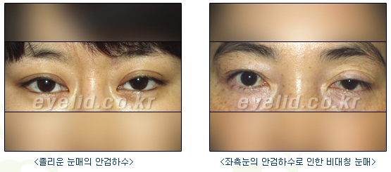 [Duhan Plastic Surgery Secondary Double Eyelid Surgery] - [Sleepy Eye Appearance, Asymmetrical Eye Appearance, Ptosis] image 5