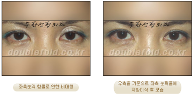 [Duhan Plastic Surgery Eye Surgery] - [Asymmetric Line, Eyelash Eversion, Deep Fixation] image 22