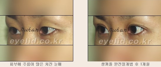 [두한성형외과 쌍커풀수술] - [눈성형 방법에 대한 자주하는 질문과 답변] 관련 이미지 134