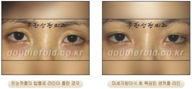 [두한성형외과 눈성형] - [풀린 쌍커풀 재수술] 관련 이미지 15