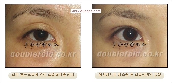 [두한성형외과 경쟁력 쌍꺼풀 재수술] - [삼중(세겹) 쌍꺼풀 라인, 눈꺼풀이 함몰된 삼중(세겹) 쌍꺼풀 라인 교정] 관련 이미지 7