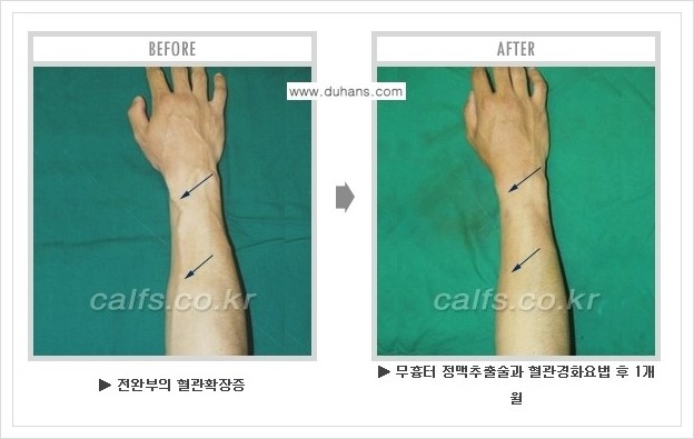 ⁠⁠[두한성형외과 정맥류 치료] - [손, 팔 정맥확장증 사진자료 안내 ②] 관련 이미지 1