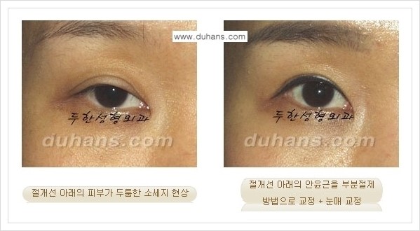 [두한성형외과 경쟁력 쌍꺼풀 재수술(극한 재수술)] - [절개선 아래가 두툼한 소세지 현상 안내] 관련 이미지 5