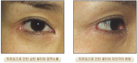 [Duhan Plastic Surgery Double Eyelid Revision] - [Inner Corner Revision, Outer Corner Revision] image 13
