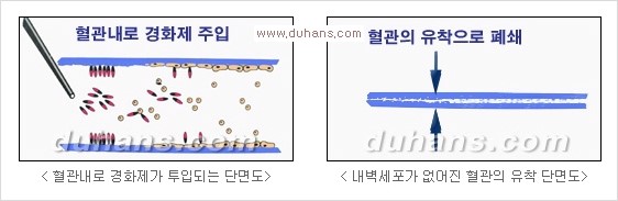 [두한성형외과 경쟁력 정맥류 치료] - [정맥류 치료의 모든 것] 관련 이미지 31