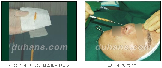 [두한성형외과 얼굴자가지방이식] - [코지방이식] 관련 이미지 7