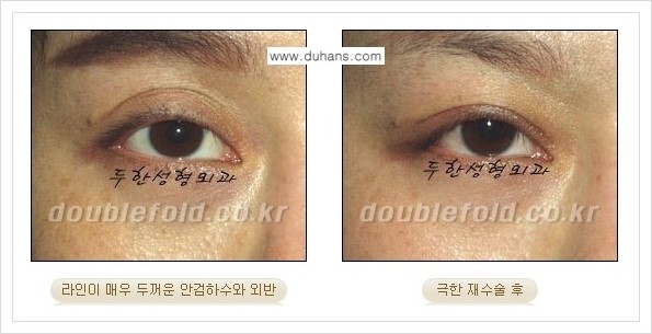 [두한성형외과 경쟁력 쌍꺼풀 재수술, 극한 재수술] - [망친 눈(쌍꺼풀) 복원수술과 일반 쌍꺼풀 재수술과의 차이점] 관련 이미지 4
