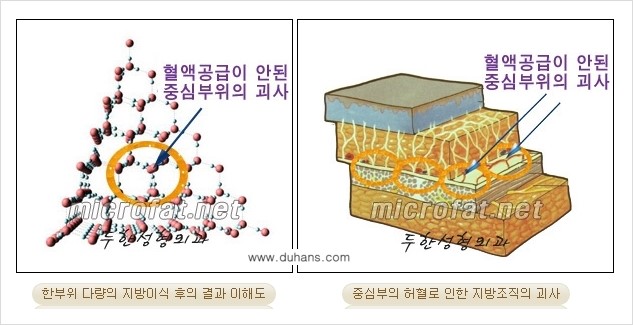 [두한성형외과 경쟁력 미세지방이식] - [3차원 입체지방이식과 2차원 평면지방이식의 차이점] 관련 이미지 3