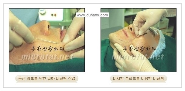 [두한성형외과 경쟁력 미세지방이식] - [두한 미세지방이식 클리닉의 특징 안내] 관련 이미지 11